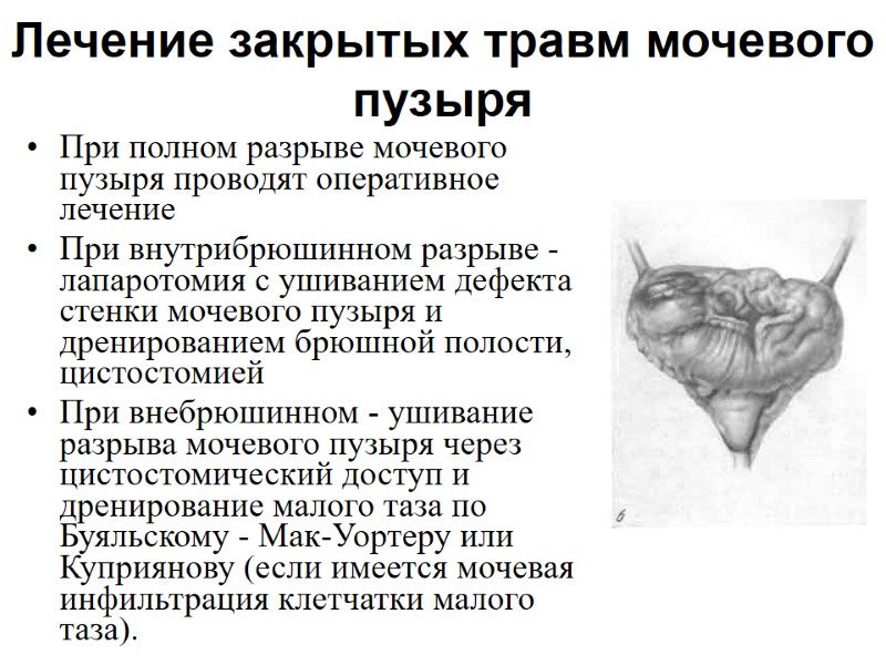 Лечение закрытых травм мочевого пузыря При полном разрыве мочевого пузыря проводят оперативное лечение При